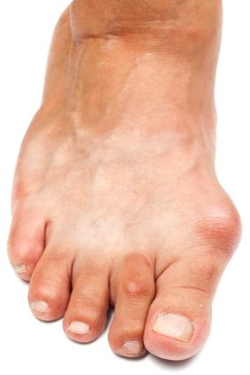Bunion in a young patient