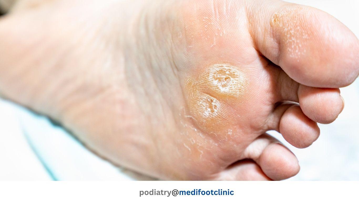 Hard skin and callus on the sole of the foot
