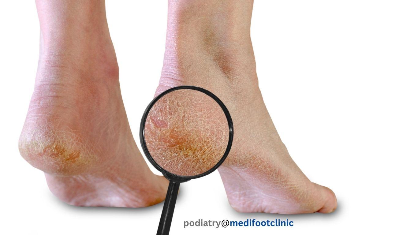 Dry cracked heels on the foot