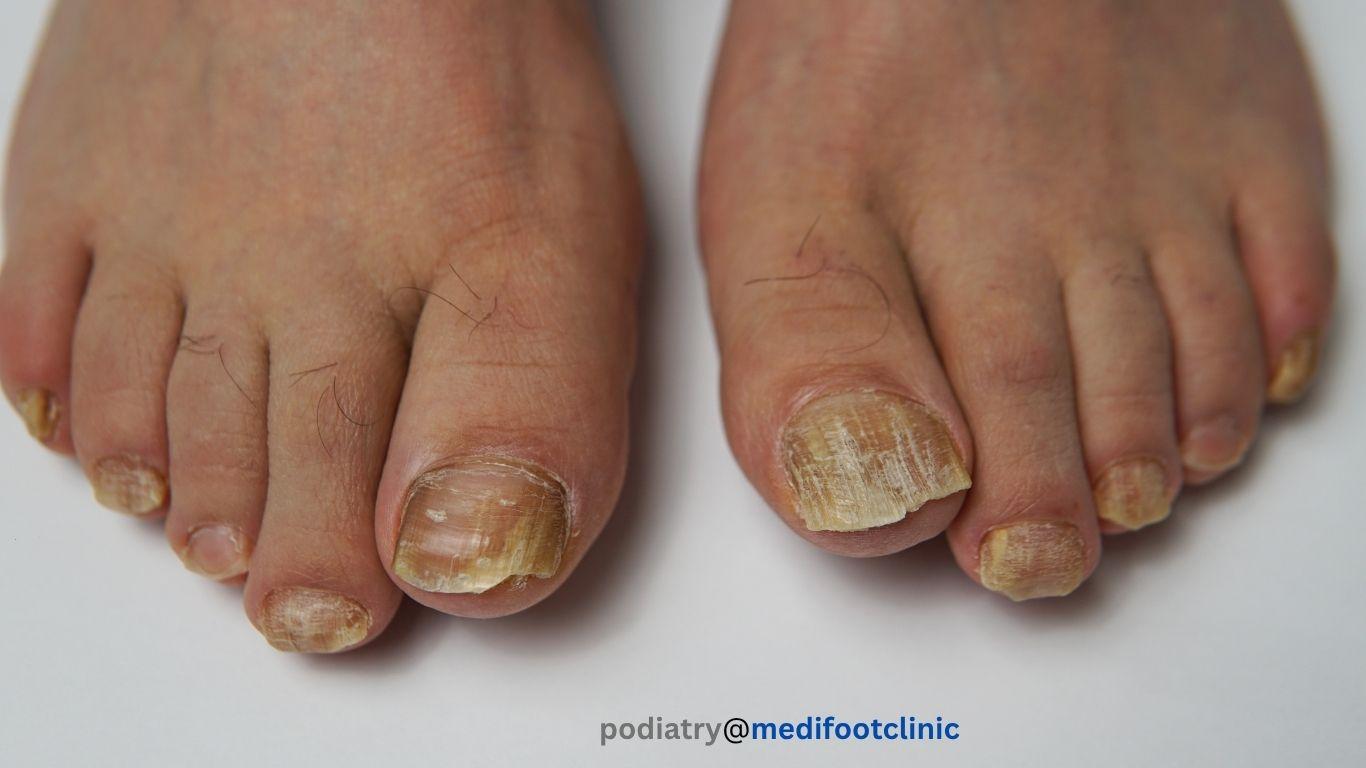 Podiatrist treating a thickened fungal toenail