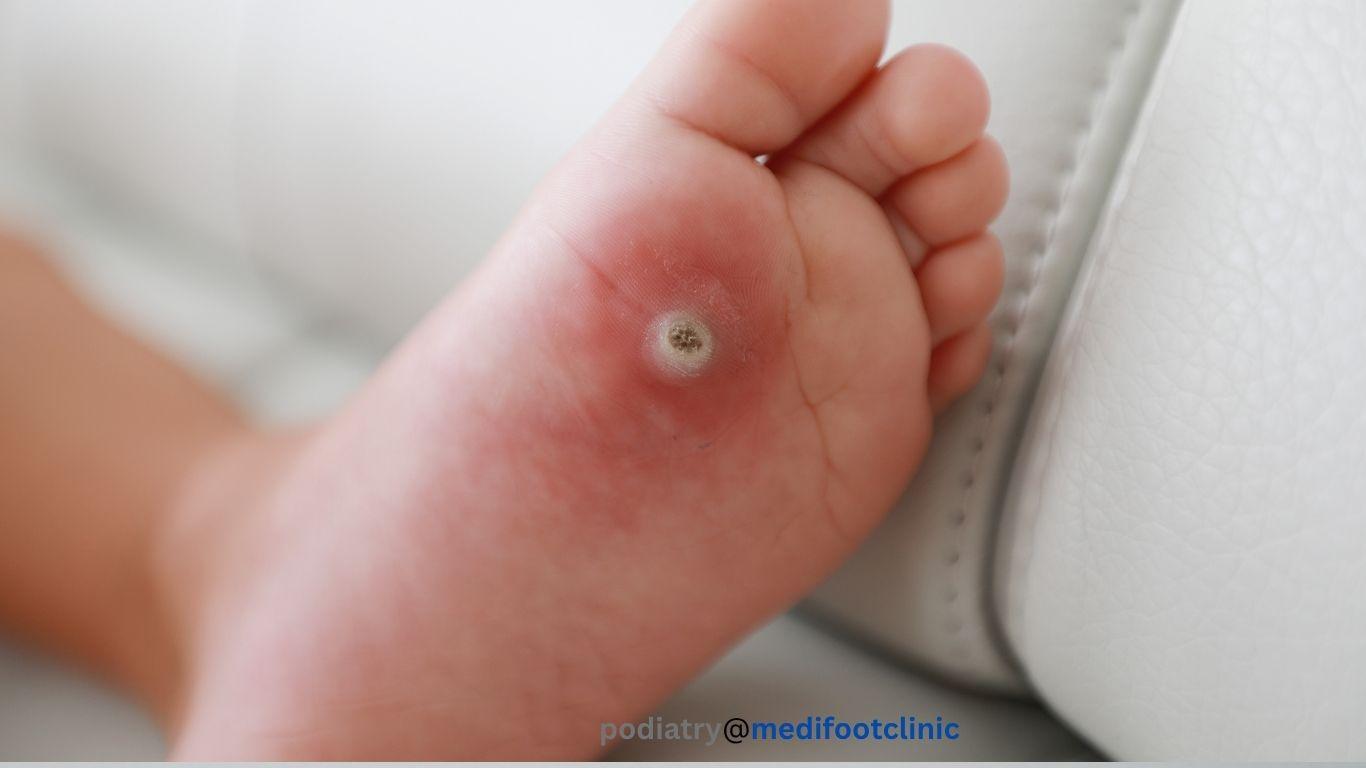 Plantar wart on the sole of the foot