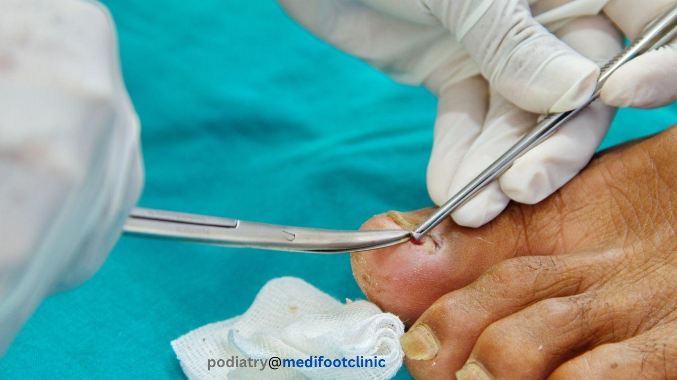 Ingrown toenail podiatry treatment